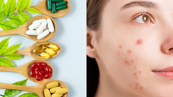 The 5 Best Vitamins for Acne Breakouts!